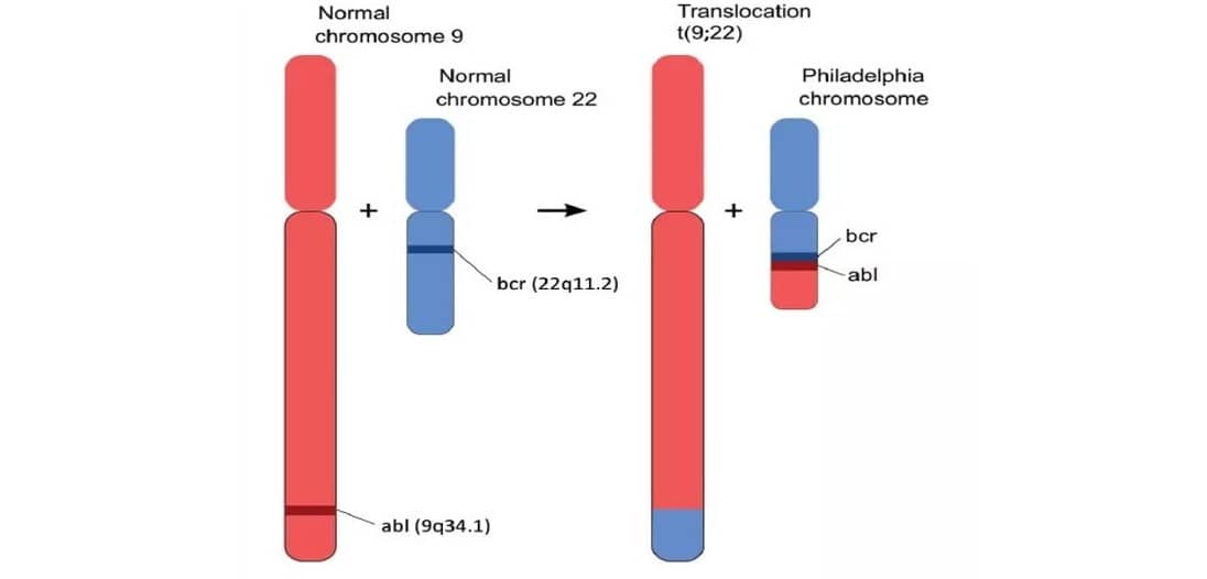 آزمایش BCR-ABL یا تشخیص کروموزوم فیلادلفیا